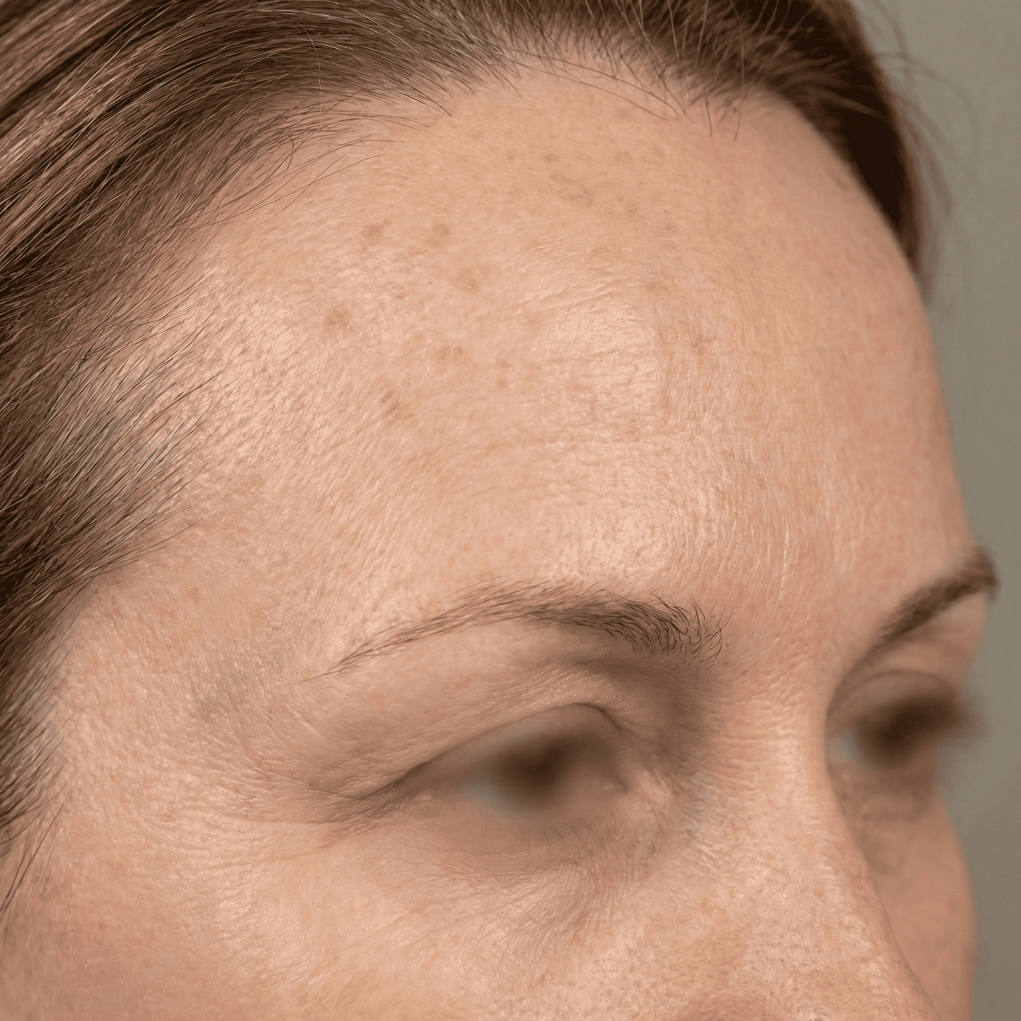 Depois do tratamento